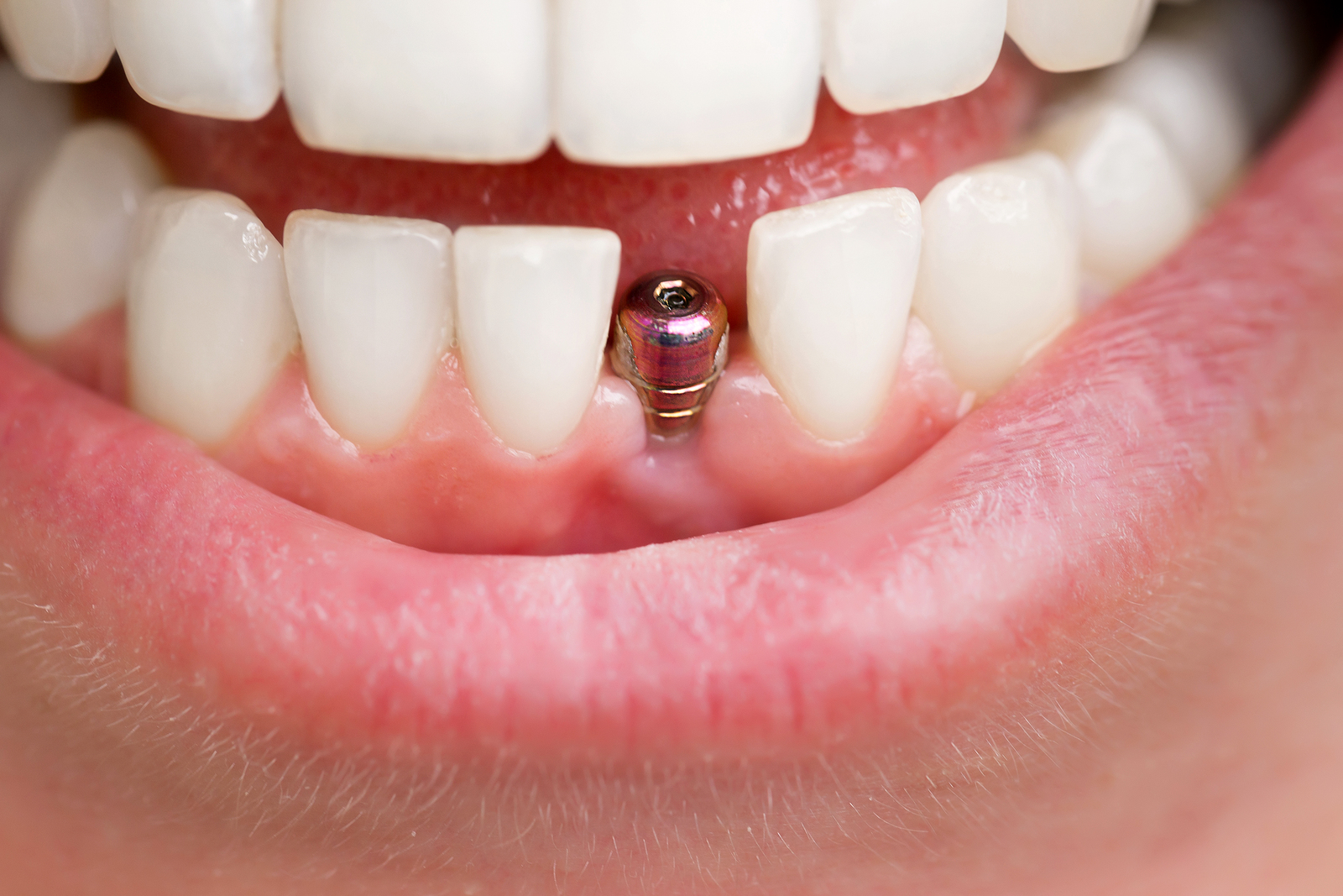 What is the First Choice for Missing Teeth?