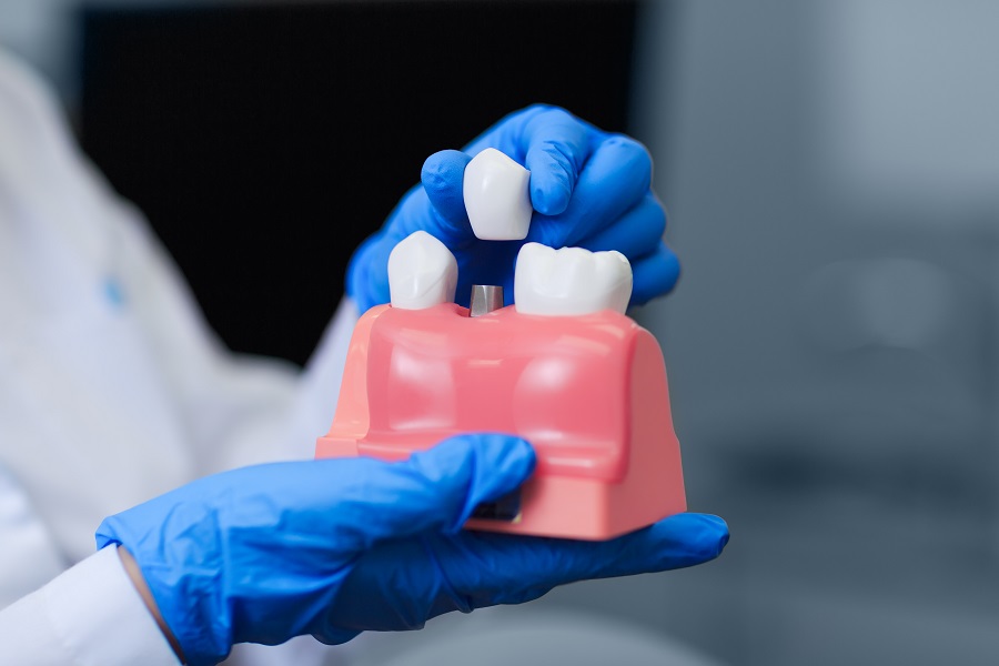 Dental Implants 101
