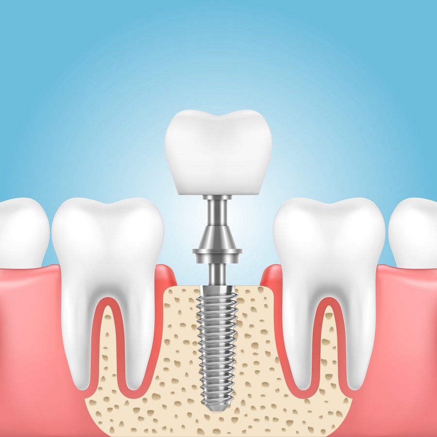 Dental Implants: Process, Benefits, and Aftercare