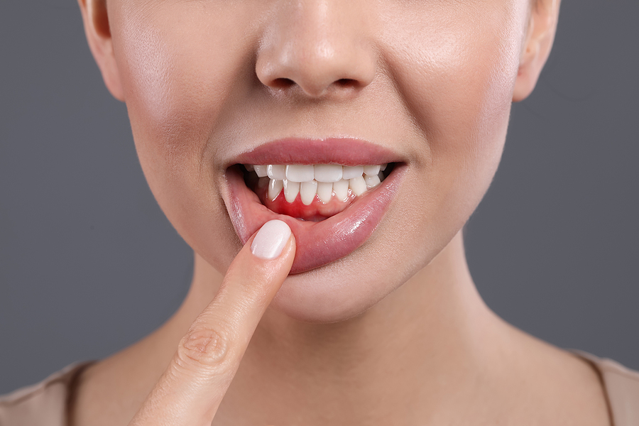 5 Main Symptoms of Gum Disease